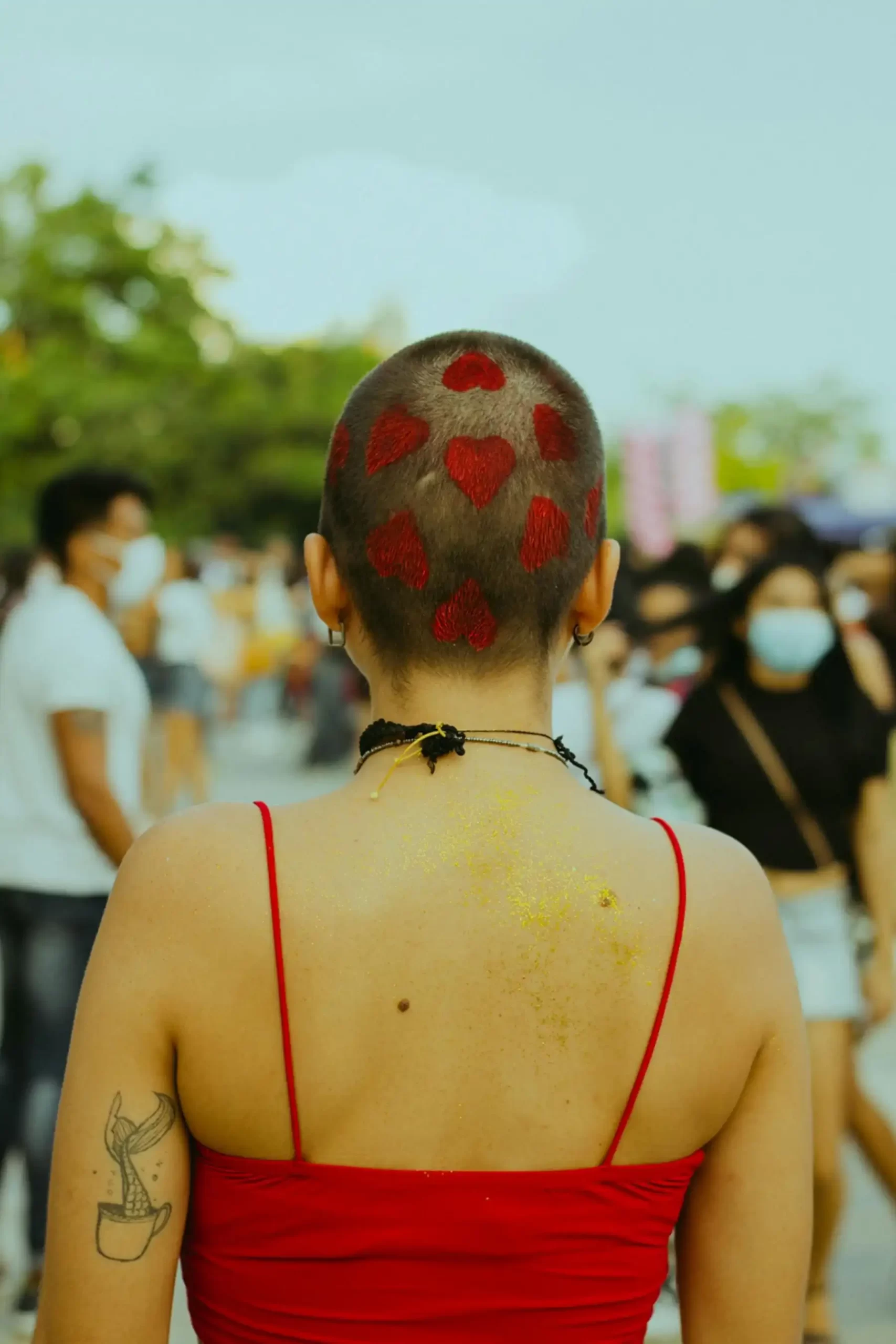 Alopecia areata